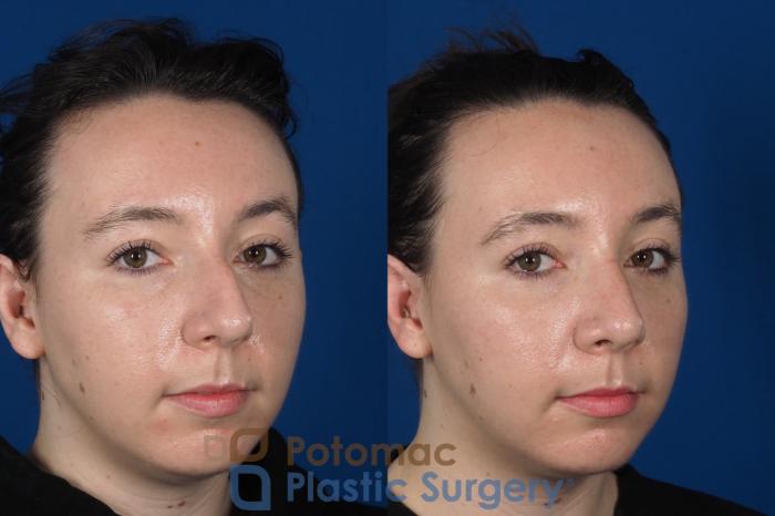 Before & After Rhinoplasty - Medical Case 294 Right Oblique 2 View in Washington DC & Arlington , DC