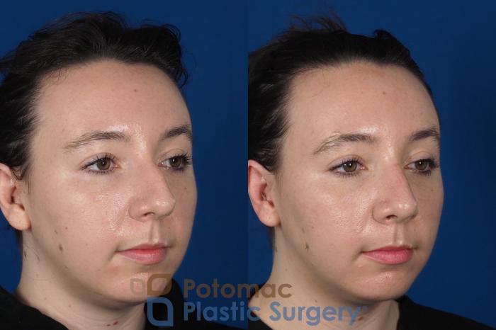 Before & After Rhinoplasty - Cosmetic Case 294 Right Oblique View in Washington DC & Arlington , DC