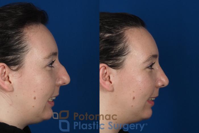 Before & After Rhinoplasty - Medical Case 294 Right Side - Smiling View in Washington DC & Arlington , DC