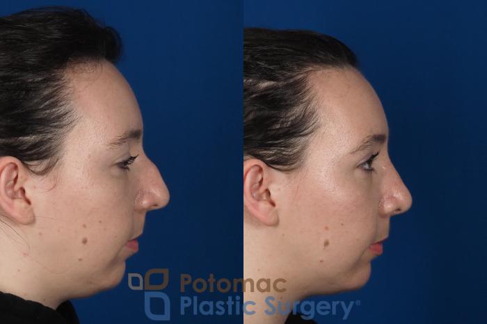 Before & After Rhinoplasty - Cosmetic Case 294 Right Side View in Washington DC & Arlington , DC
