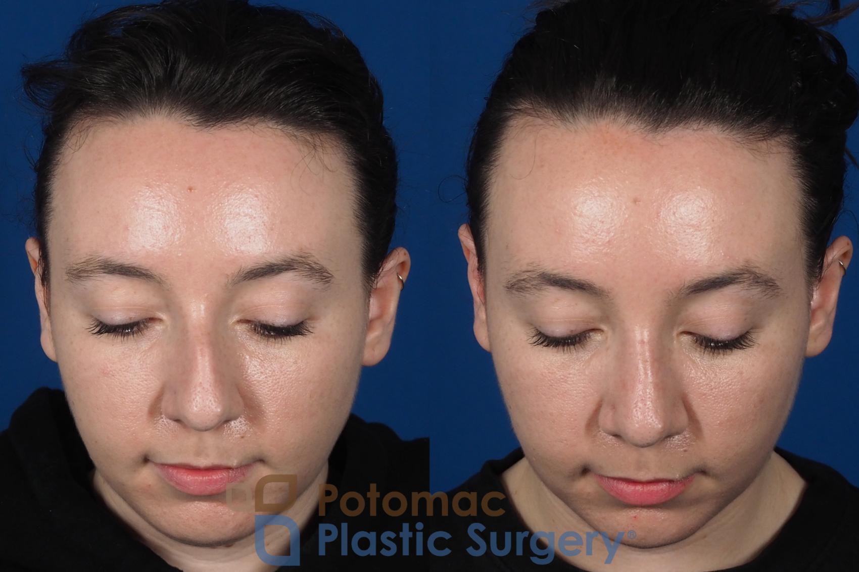 Before & After Rhinoplasty - Cosmetic Case 294 Top View in Washington DC & Arlington , DC