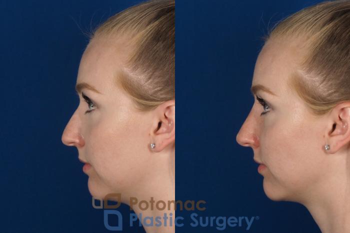 Before & After Rhinoplasty - Cosmetic Case 296 Left Side View in Washington DC & Arlington , DC