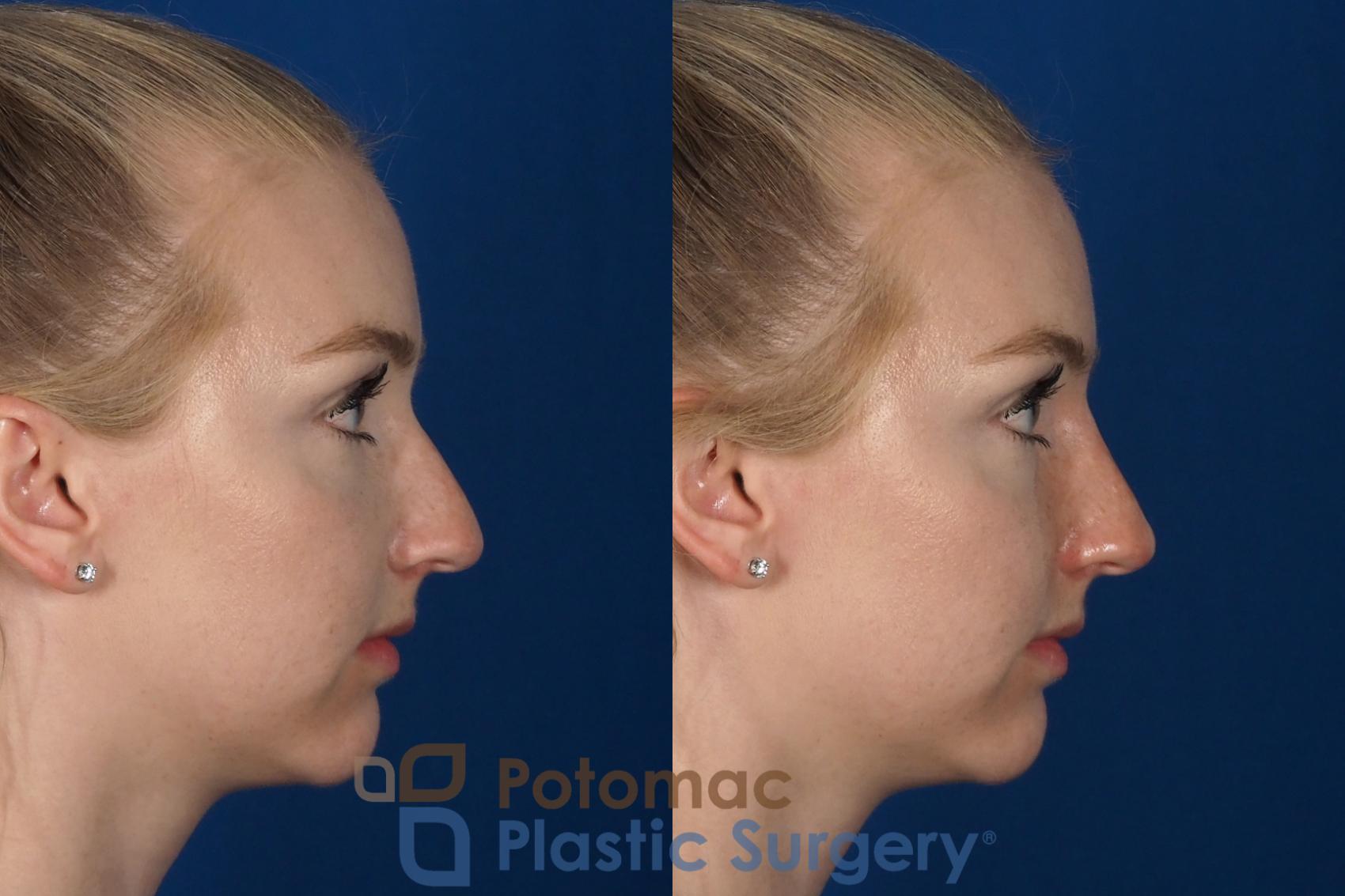 Before & After Rhinoplasty - Cosmetic Case 296 Right Side View in Washington DC & Arlington , DC