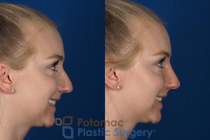 Before & After Rhinoplasty - Cosmetic Case 296 Right - Smiling View in Washington DC & Arlington , DC