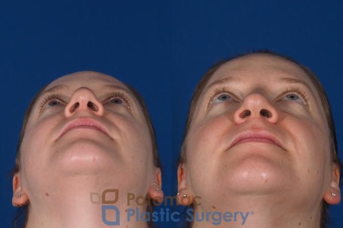Before & After Rhinoplasty - Cosmetic Case 297 Bottom View in Washington DC & Arlington , DC