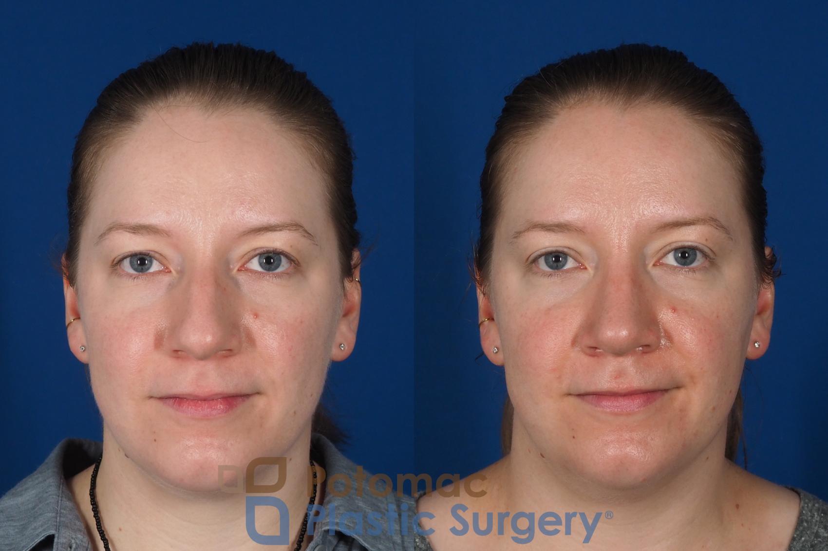 Before & After Rhinoplasty - Cosmetic Case 297 Front View in Washington DC & Arlington , DC
