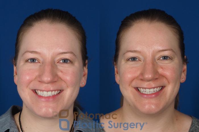 Before & After Rhinoplasty - Cosmetic Case 297 Front - Smiling View in Washington DC & Arlington , DC