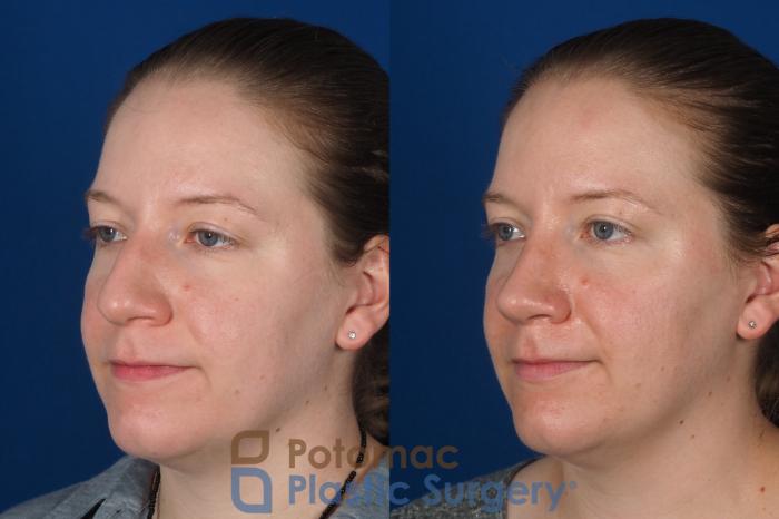 Before & After Rhinoplasty - Cosmetic Case 297 Left Oblique View in Washington DC & Arlington , DC
