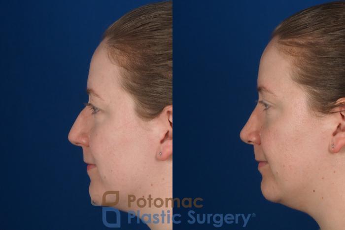 Before & After Rhinoplasty - Cosmetic Case 297 Left Side View in Washington DC & Arlington , DC