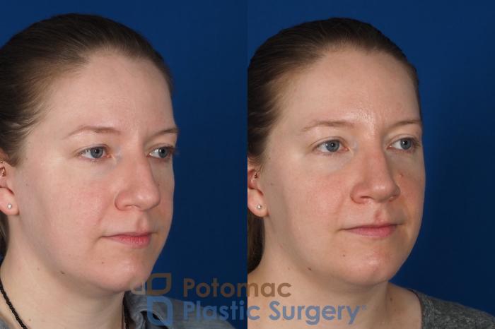 Before & After Rhinoplasty - Cosmetic Case 297 Right Oblique View in Washington DC & Arlington , DC