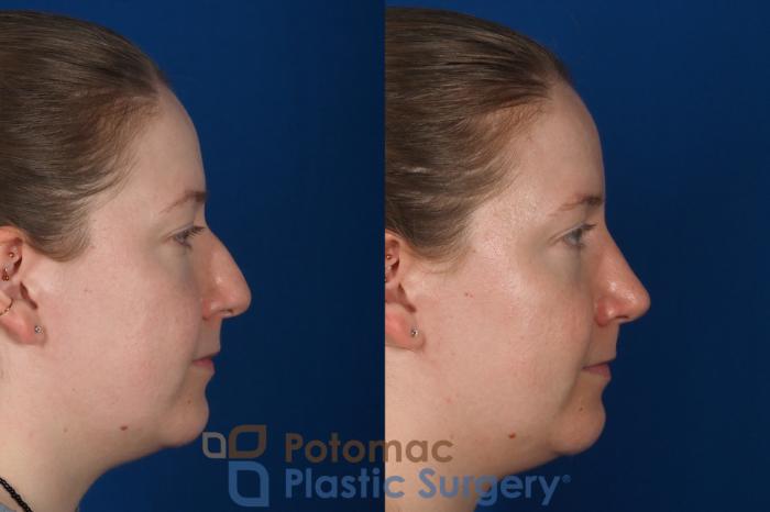Before & After Rhinoplasty - Cosmetic Case 297 Right Side View in Washington DC & Arlington , DC