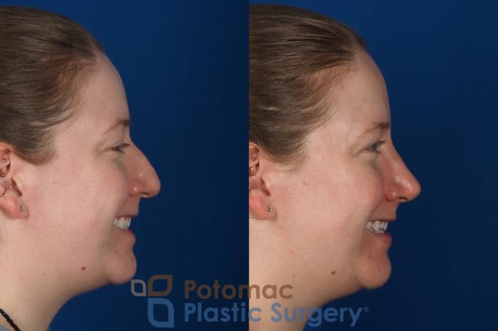 Before & After Rhinoplasty - Cosmetic Case 297 Right - Smiling View in Washington DC & Arlington , DC