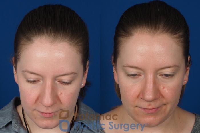 Before & After Rhinoplasty - Cosmetic Case 297 Top View in Washington DC & Arlington , DC