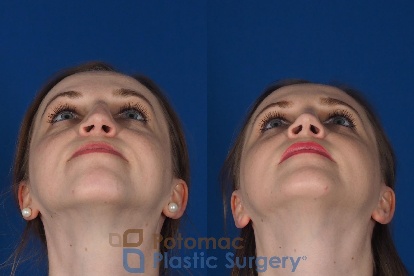 Before & After Rhinoplasty - Cosmetic Case 298 Bottom View in Washington, DC