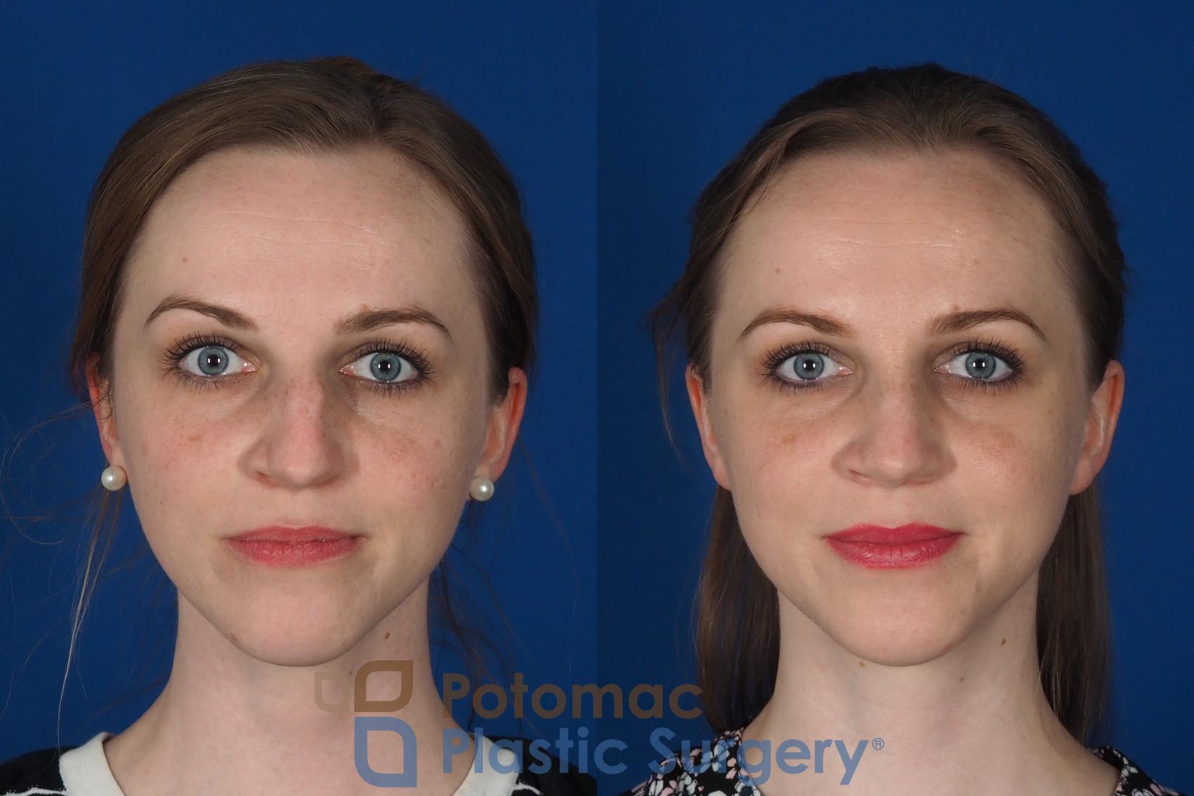 Before & After Rhinoplasty - Cosmetic Case 298 Front View in Washington, DC