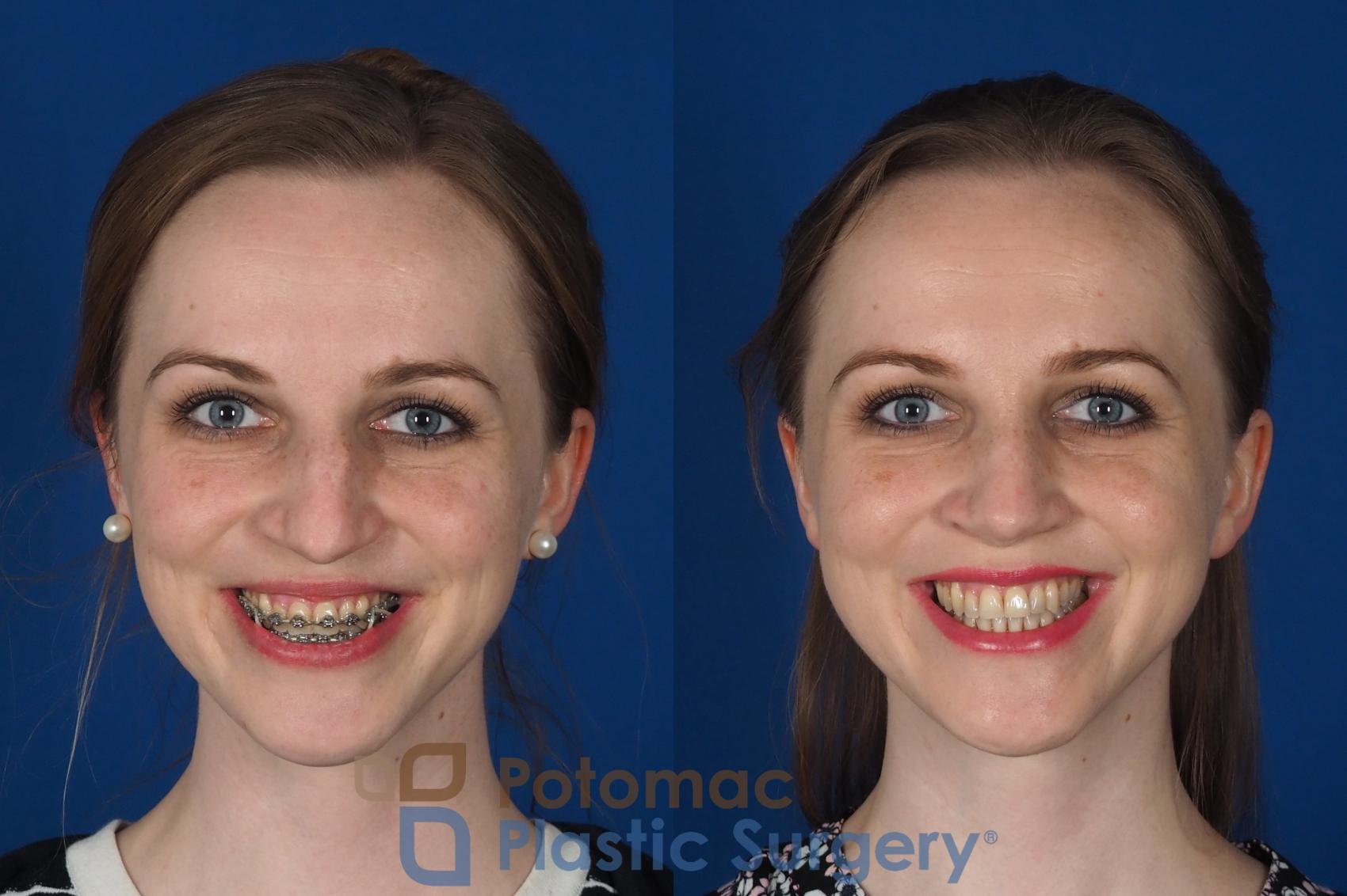Before & After Rhinoplasty - Cosmetic Case 298 Front - Smiling View in Washington, DC