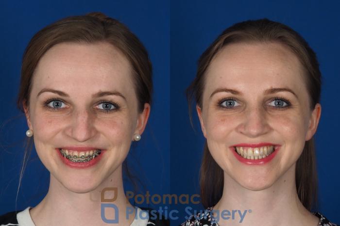 Before & After Rhinoplasty - Cosmetic Case 298 Front - Smiling View in Washington DC & Arlington , DC