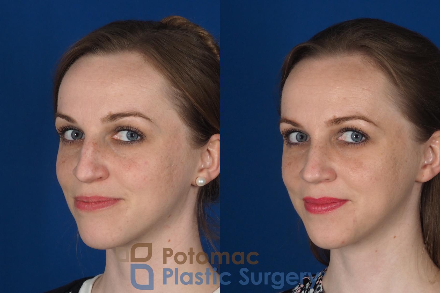 Before & After Rhinoplasty - Cosmetic Case 298 Left Oblique 2 View in Washington, DC