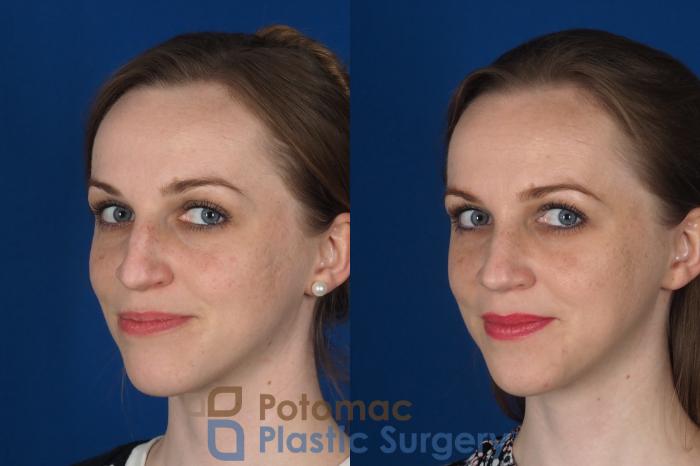 Before & After Rhinoplasty - Cosmetic Case 298 Left Oblique 2 View in Washington DC & Arlington , DC