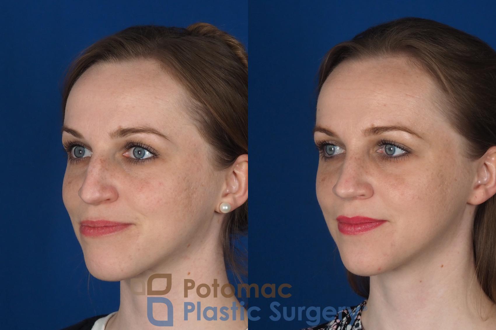 Before & After Rhinoplasty - Cosmetic Case 298 Left Oblique View in Washington, DC