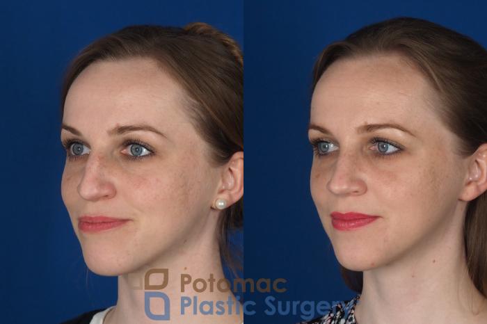 Before & After Rhinoplasty - Cosmetic Case 298 Left Oblique View in Washington DC & Arlington , DC