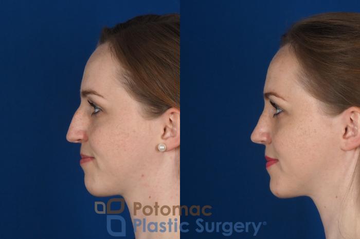 Before & After Rhinoplasty - Cosmetic Case 298 Left Side View in Washington DC & Arlington , DC