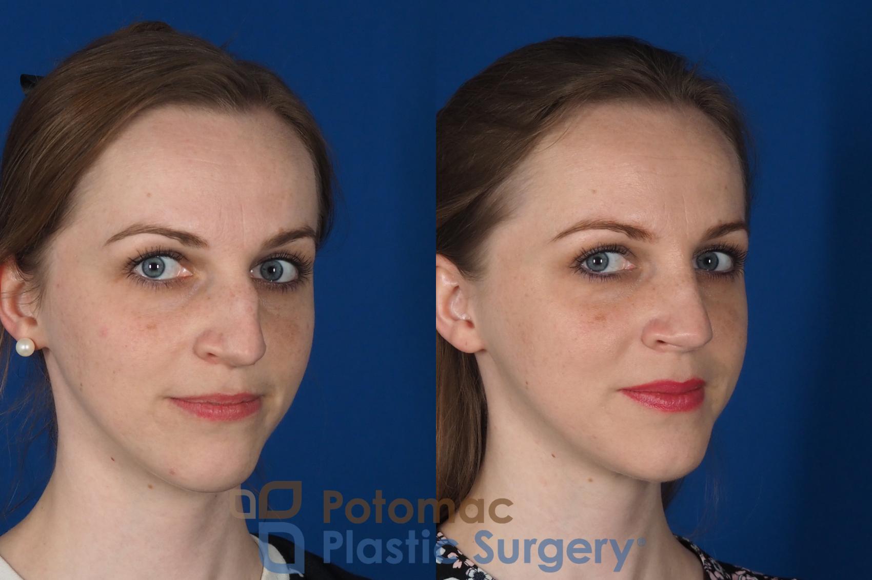 Before & After Rhinoplasty - Cosmetic Case 298 Right Oblique 2 View in Washington, DC