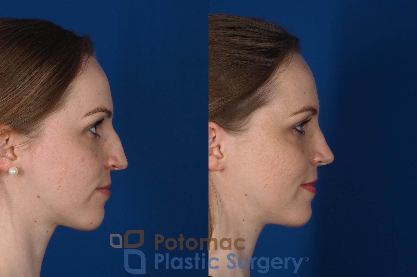 Before & After Rhinoplasty - Cosmetic Case 298 Right Side View in Washington, DC