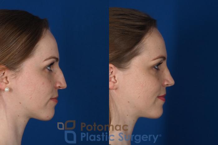 Before & After Rhinoplasty - Cosmetic Case 298 Right Side View in Washington DC & Arlington , DC