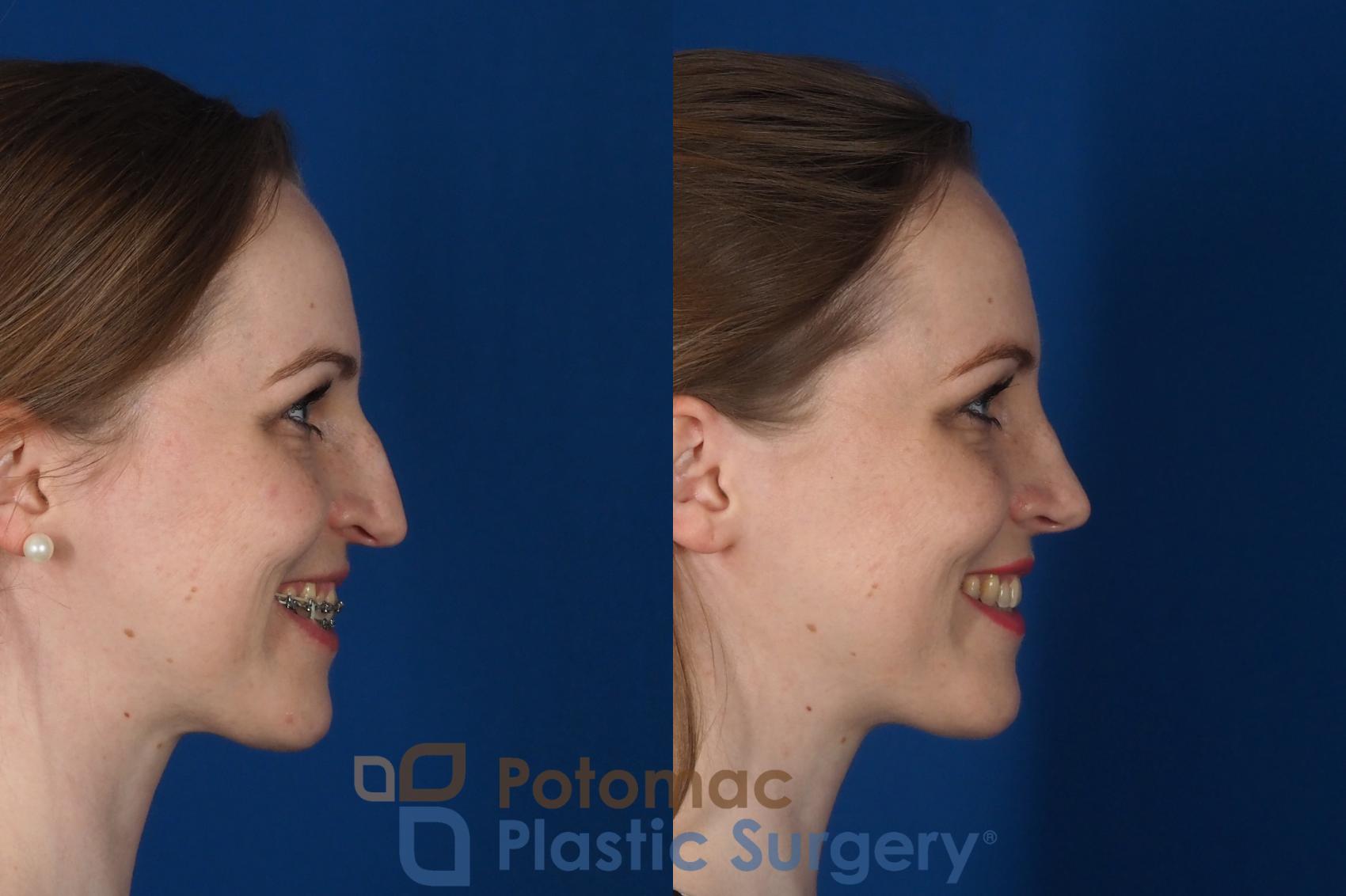 Before & After Rhinoplasty - Cosmetic Case 298 Right - Smiling View in Washington, DC