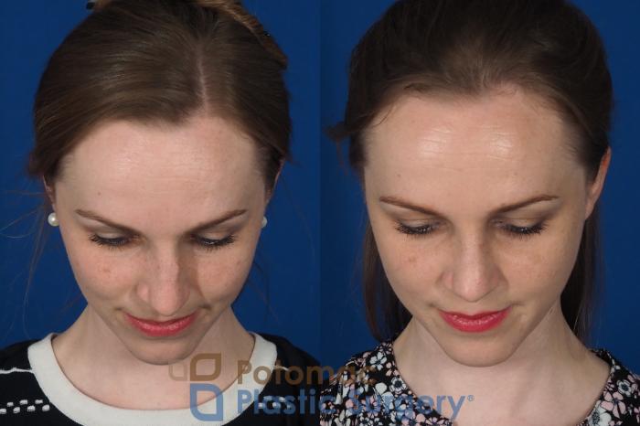 Before & After Rhinoplasty - Cosmetic Case 298 Top View in Washington DC & Arlington , DC