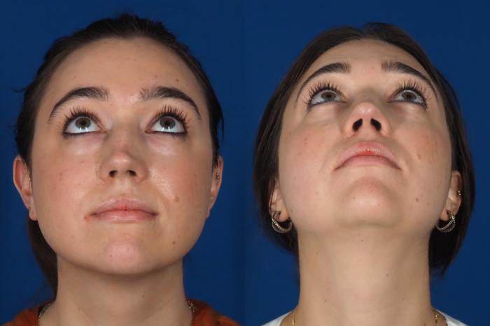 Before & After Rhinoplasty - Medical Case 301 Bottom View in Washington DC & Arlington , DC