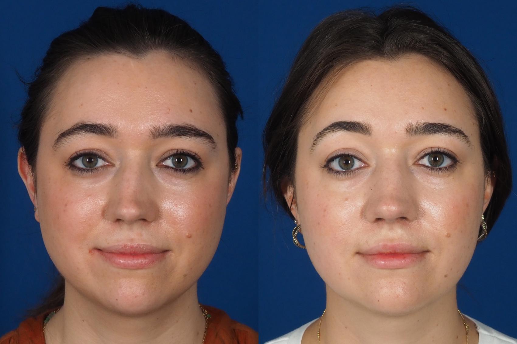Before & After Rhinoplasty - Cosmetic Case 301 Front View in Washington DC & Arlington , DC