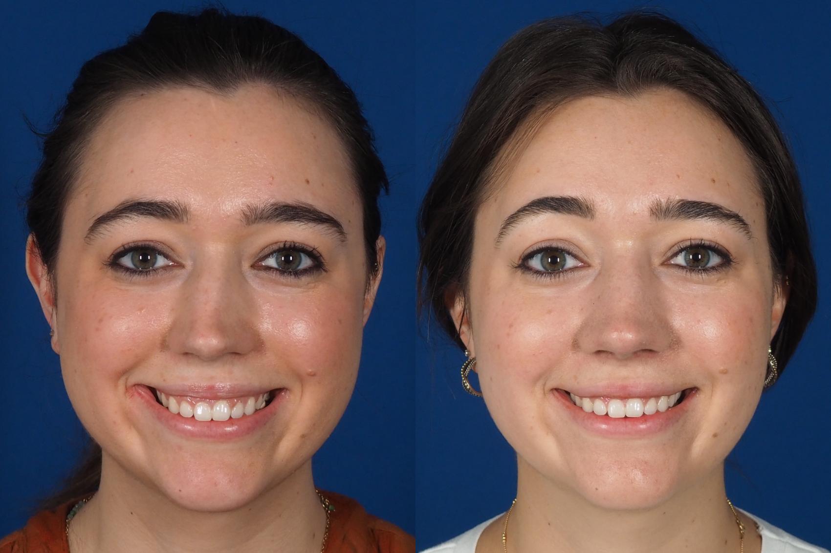 Before & After Rhinoplasty - Cosmetic Case 301 Front - Smiling View in Washington DC & Arlington , DC