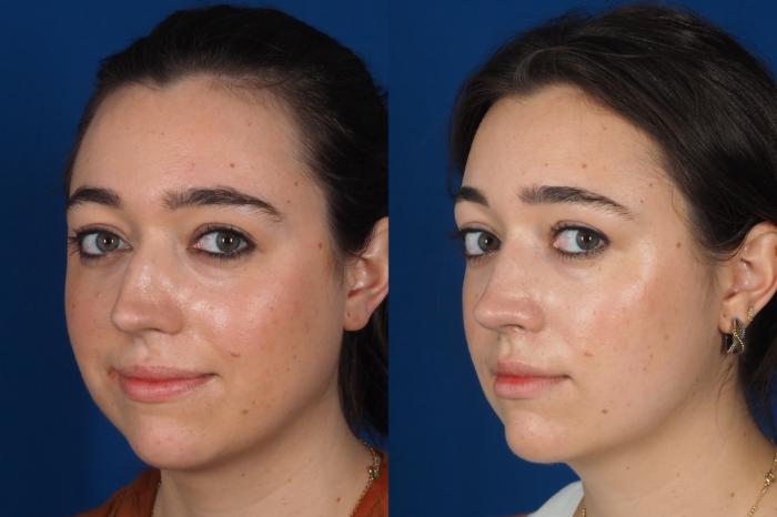 Before & After Rhinoplasty - Medical Case 301 Left Oblique 2 View in Washington DC & Arlington , DC