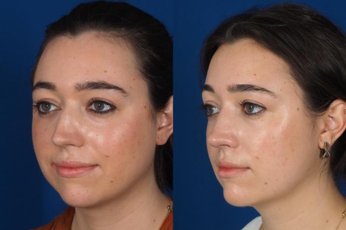 Before & After Rhinoplasty - Medical Case 301 Left Oblique View in Washington DC & Arlington , DC