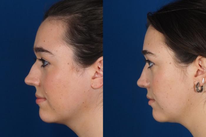 Before & After Rhinoplasty - Cosmetic Case 301 Left Side View in Washington DC & Arlington , DC