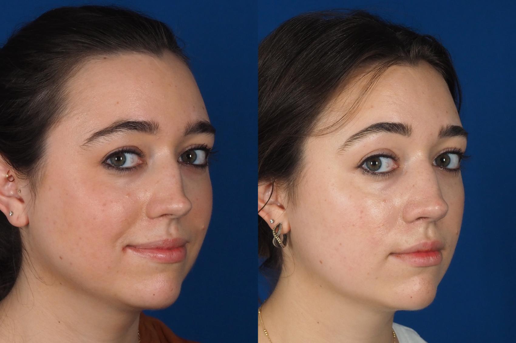 Before & After Rhinoplasty - Cosmetic Case 301 Right Oblique 2 View in Washington DC & Arlington , DC