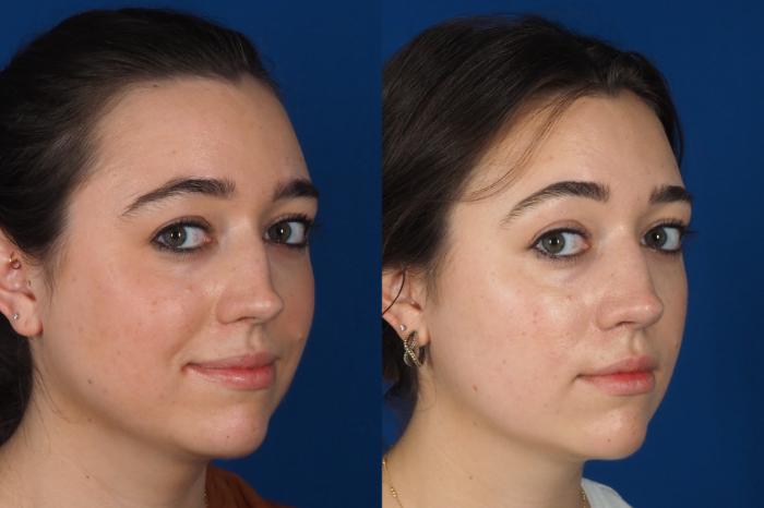 Before & After Rhinoplasty - Medical Case 301 Right Oblique 2 View in Washington DC & Arlington , DC