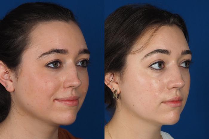 Before & After Rhinoplasty - Medical Case 301 Right Oblique View in Washington DC & Arlington , DC
