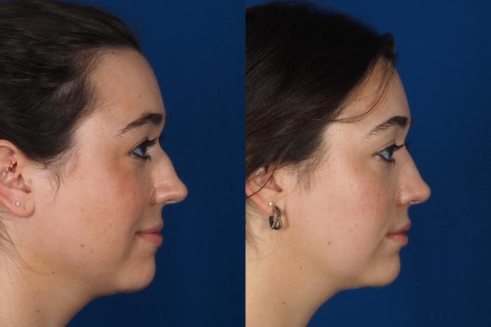 Before & After Rhinoplasty - Cosmetic Case 301 Right Side View in Washington DC & Arlington , DC