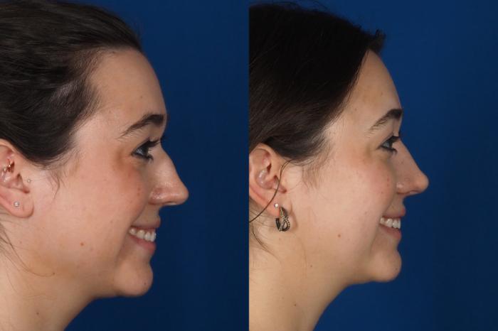Before & After Rhinoplasty - Medical Case 301 Right - Smiling View in Washington DC & Arlington , DC