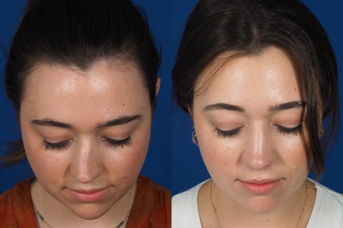 Before & After Rhinoplasty - Cosmetic Case 301 Top View in Washington DC & Arlington , DC