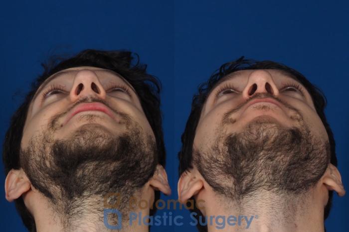 Before & After Rhinoplasty - Cosmetic Case 303 Bottom View in Washington DC & Arlington , DC