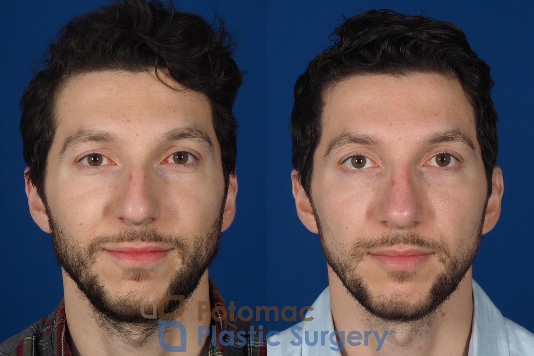Before & After Rhinoplasty - Medical Case 303 Front View in Washington, DC