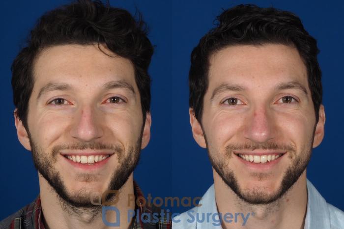 Before & After Rhinoplasty - Medical Case 303 Front - Smiling View in Washington DC & Arlington , DC
