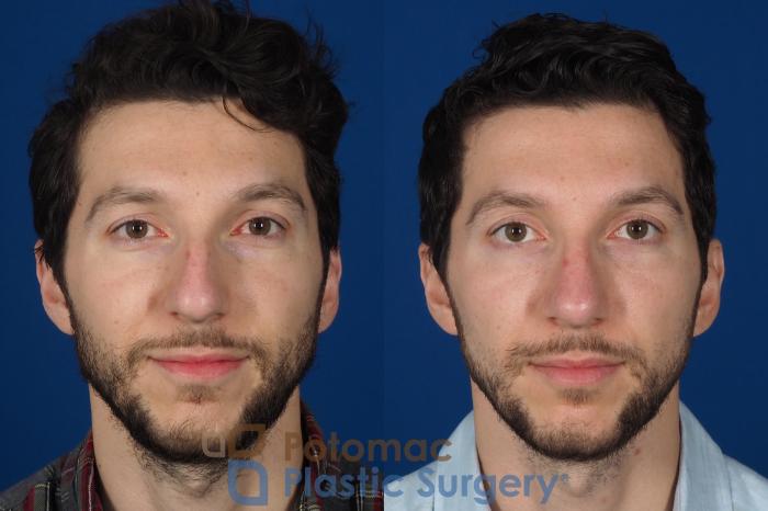 Before & After Rhinoplasty - Cosmetic Case 303 Front View in Washington, DC