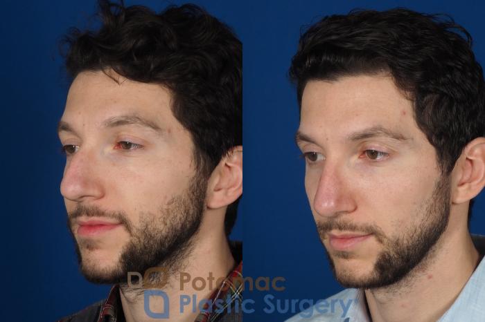 Before & After Rhinoplasty - Medical Case 303 Left Oblique View in Washington DC & Arlington , DC