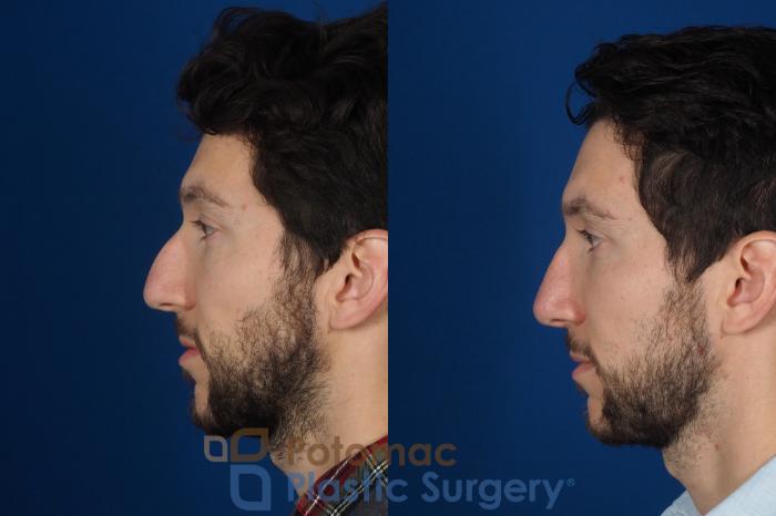 Before & After Rhinoplasty - Medical Case 303 Left Side View in Washington DC & Arlington , DC