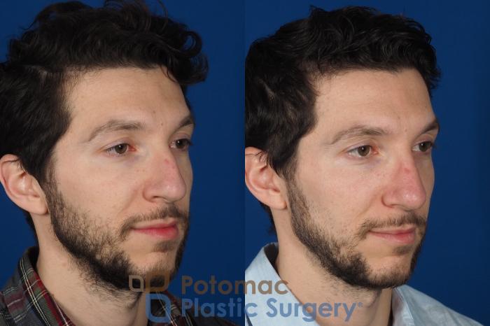 Before & After For Men Case 303 Right Oblique View in Washington DC & Arlington , DC